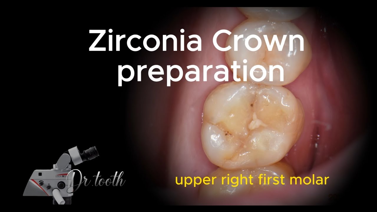Zirconia Crown Preparation Of Upper First Molar zirconia-crown-preparation-of-upper-first-molar