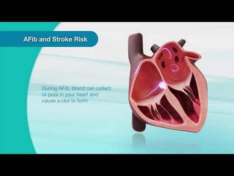 Atrial Fibrillation-Ablacija na srce