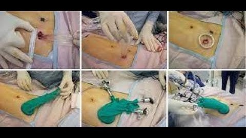 Laparoscopy colectomy CPT code - simplify medical coding