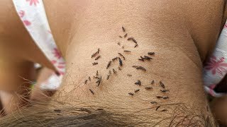 Getting out hundred lice from head - Remove thousand lice from hair