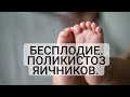 Бесплодие. Нарушение менструального цикла, ановуляция. Синдром поликистозных яичников.