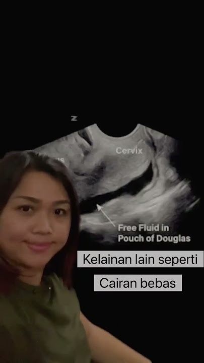 Apa Yang Bisa Kita Lihat Saat USG Transvaginal ?
