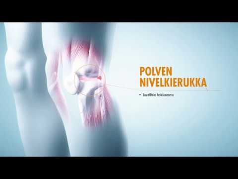 Video: Polven Artroskopia: Syyt, Menettely Ja Edut