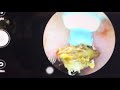 Grossest Ear Cleaning Video on the Internet | Most Disgusting Hairy Wax Removal | Is it worth it?
