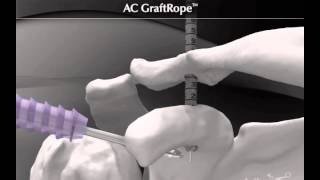 AC GraftRope