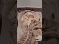 Cerebrum- Blood supply.