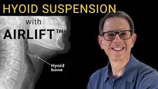 Hyoid Suspension For Osa