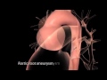 Aortic Disease: Aortic Aneurysm and Dissection