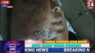 PONIRIN WARGA TIYUH MAKARTI PENDERITA KANKER GETAH BENING HARAPKAN BANTUAN PENGOBATAN