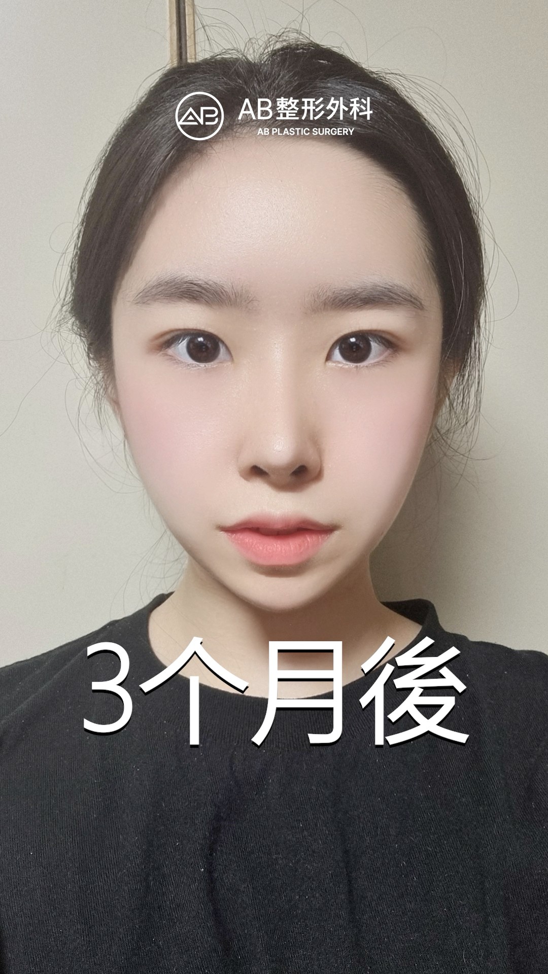 三個月後的改變太驚人！削骨＋鼻子重修分享 #shorts