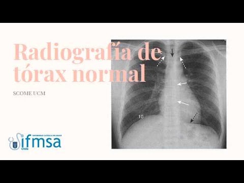 Video: 11 formas de saber si una radiografía de tórax está rotada