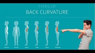 Flatback Syndrome Assessment