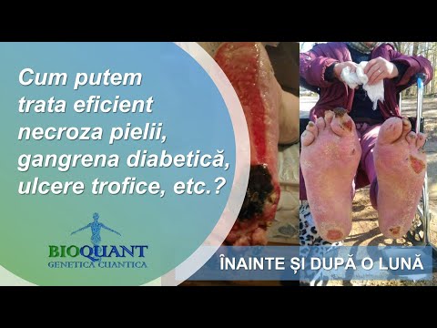 Video: Tratamentul Gangrenei Fără Amputare