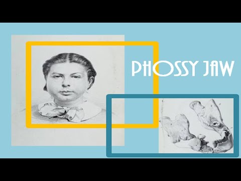 Phossy jaw // Phosphorus necrosis of the jaw