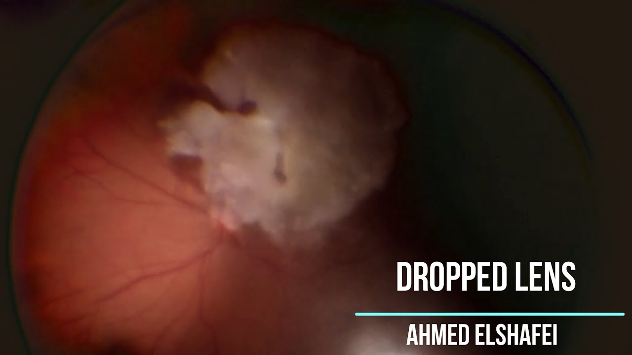 Dropped Nucleus in Cataract Surgery YouTube