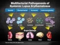 Scientific and Clinical Insights Into the Pathophysiology of Systemic Lupus Erythematosus
