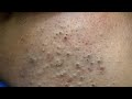Deep Pore Cleansing For Blackheads / Korean Skincare Routine