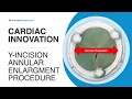 Cardiac innovation yincision annular enlargement procedure with dr bo yang