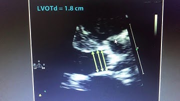 Aortic stenosis- area by continuity equation