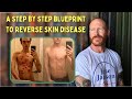 Revealing the complete step by step BLUEPRINT for permanent eczema, psoriasis, dermatitis reversal