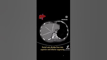 Liver segments on CT scan #CT #radiology #radiologist #liver