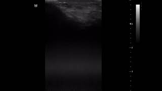CASE 987 ultrasound aneurysmal bone cyst  vs giant cell tumour