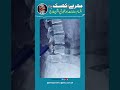 🏥 Spondylolisthesis (Back Bone Slip) Treatment