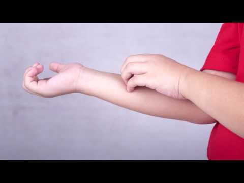 Video: Eczema Nei Bambini - Cause E Sintomi Dell'eczema Nei Bambini