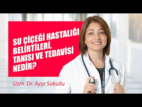 Su çiçeği hastalığı belirtileri, tanısı ve tedavisi nedir?