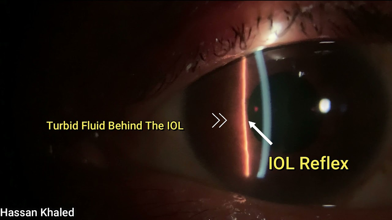 Cataract Surgical Complications - American Academy of Ophthalmology