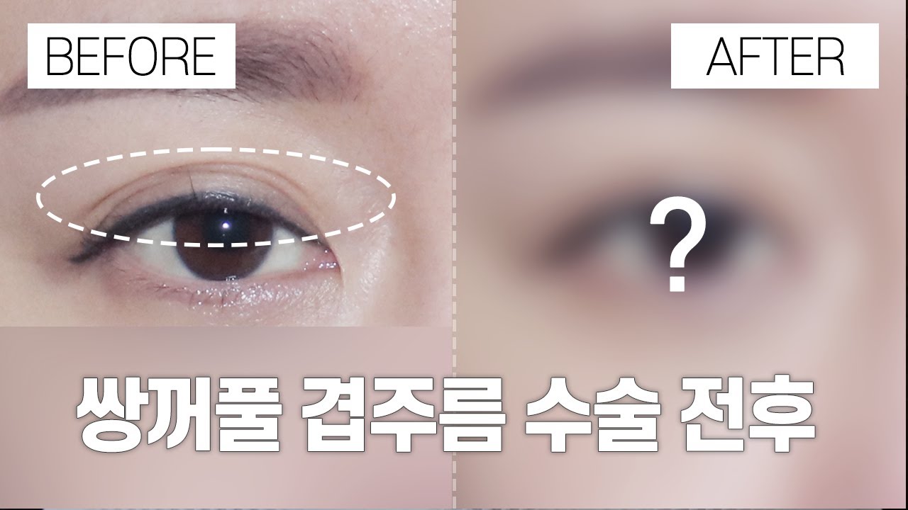 [Gangnam Seoyeon Plastic Surgery] Phẫu thuật mắt hai mí nếp gấp l Review video thực tế l Gangnam Seoyeon Plastic Surgery