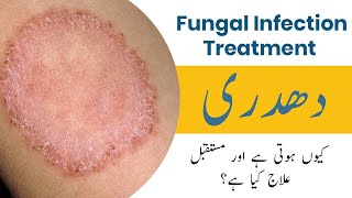 Fungal Infection Treatment in Urdu/Hindi - Dadri ka ilaj in Urdu/Hindi - Ringworm Treatment