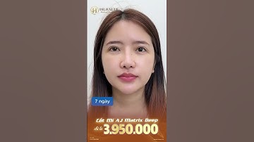 Cắt mí A.I Matrix Deep   Đỉnh cao công nghệ cắt mí