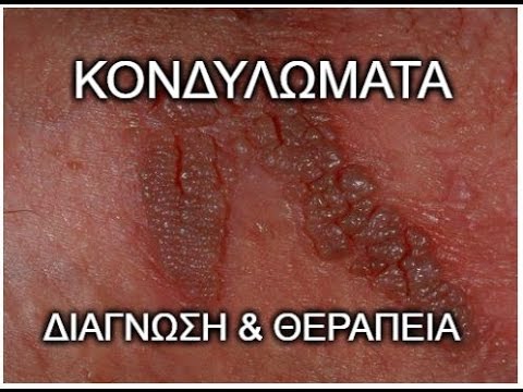 Κονδυλώματα HPV