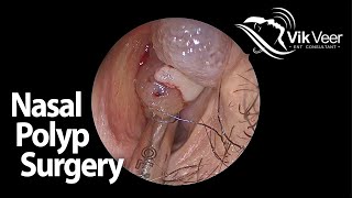 Watch me remove Polyps from the nose!