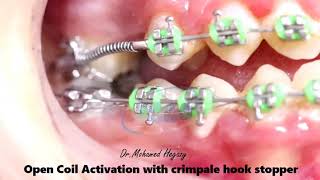 Crimpable hooks stopper for open coil activation | أفضل دكتور اسنان فى المنوفية