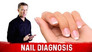 What do Your Nails Say About Your Health & Nutrition? – Dr.Berg screenshot 5