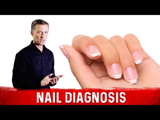 9 Symtomatic Types Of Nails And What They Could Indicate About Your Health  - Health - Nigeria