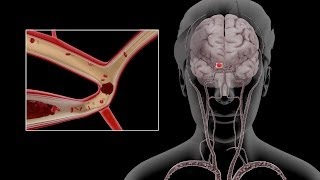 Carotid Dissection