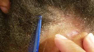 Powder Flakes Dandruff Scratching (Recorded in July)