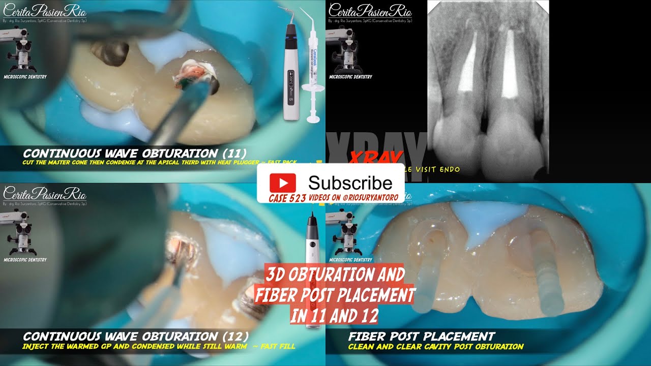 CONTINUOUS WAVE OBTURATION BIOCERAMIC SEALER USING FASTFILL FASTPACK