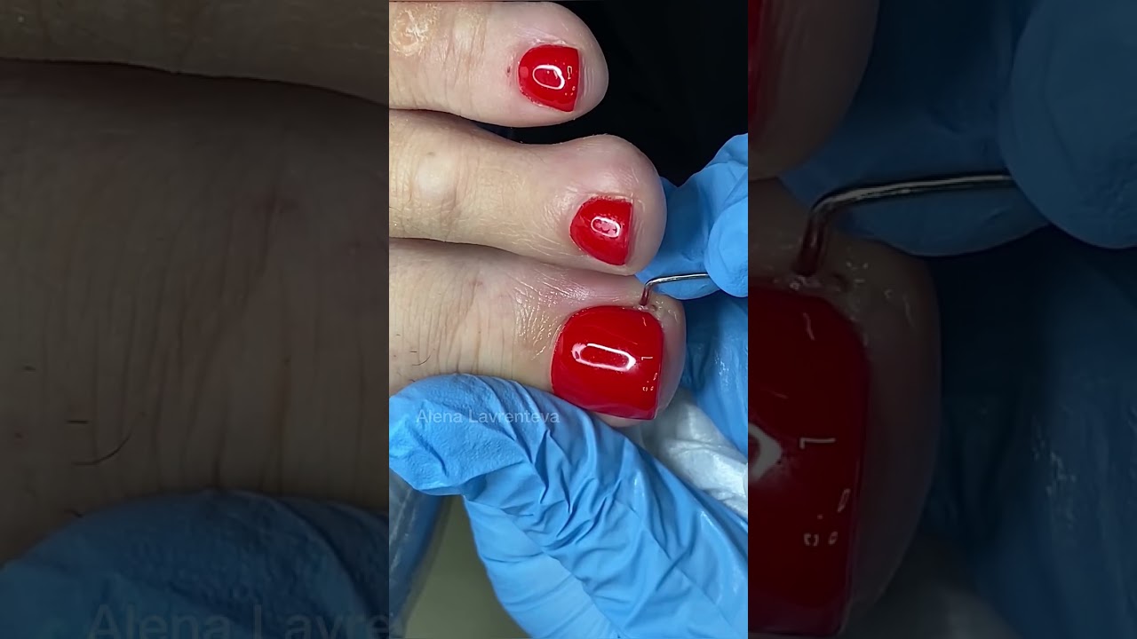 ВРОС НОГОТЬ И ЗАГНОИЛСЯ ПАЛЕЦ! ЧТО ДЕЛАТЬ? ЧЕМ ПОКРЫТЬ НОГОТЬ НА НОГЕ ЕСЛИ ОН ВРОС В БОКОВОЙ ВАЛИК?