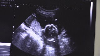Мальчик или девочка? 3D УЗИ, допплерография. 18 недель беременности