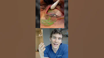 Removing 23 Contact Lenses Stuck in Eye Reaction