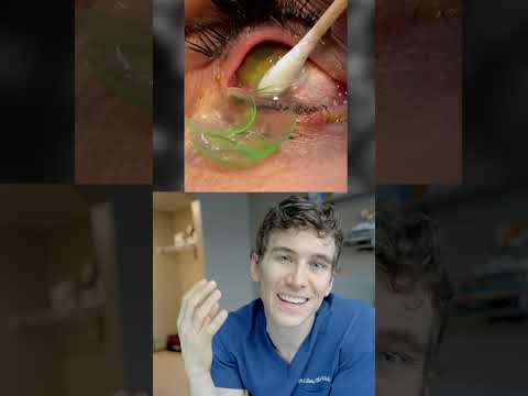 Video: Sådan fjernes bløde kontaktlinser, når du har sovet med dem