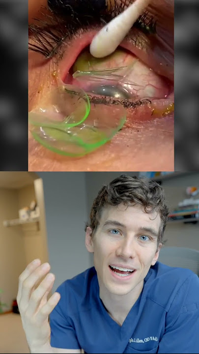 Removing 23 Contact Lenses Stuck in Eye Reaction