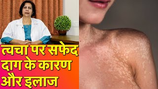 त्वचा पर सफेद दाग के कारण और ईलाज || Treatment of White Patches on Skin