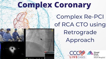 Complex Re-PCI of RCA CTO using Retrograde Approach