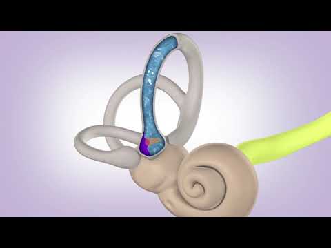 BPPV Cupulolithiasis