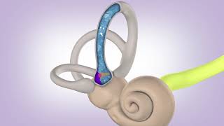 BPPV Cupulolithiasis